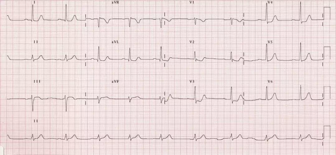 心电图和心脏彩超以哪个为准,心电图和心脏超声是一样吗