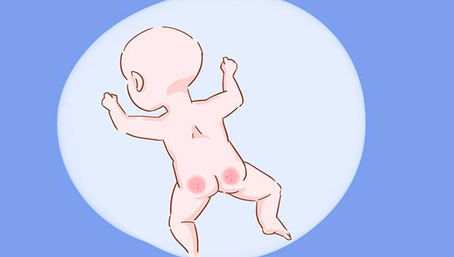 宝宝屁股破皮怎么护理好得快,一个月宝宝屁股破皮怎么快速愈合