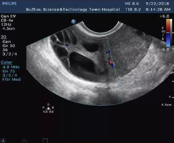 彩超查出卵巢多囊样改变，是不是怀孕就困难了？