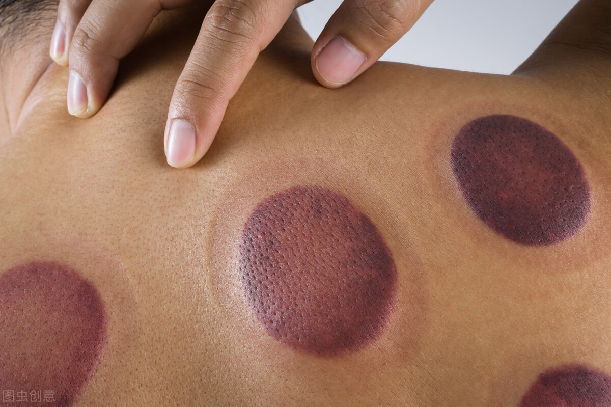 拔罐后紫黑色说明湿气重吗,拔罐后黑紫是湿气拔出来了吗