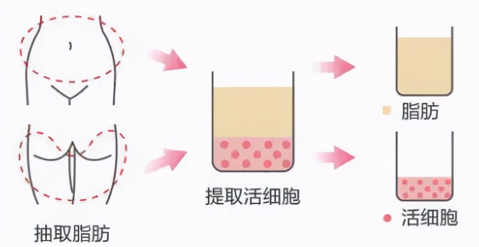 面部填充到底推荐做吗,面部填充脸部凹陷有风险吗