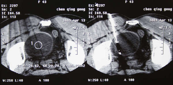 什么是癌症冷冻治疗？对比其他微创介入技术，冷冻治疗有哪些优势