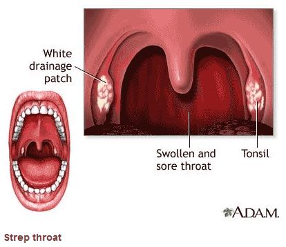 宝宝发烧喉咙痛怎么办最有效,6岁宝宝喉咙痛是怎么回事
