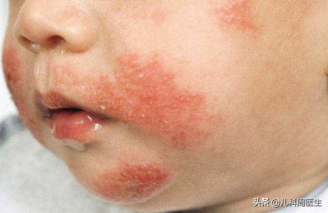 宝宝长痱子淹脖子怎么办,痱子和湿疹的预防和护理