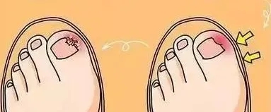 指甲老往肉里长化脓,指甲为什么一直往肉里长