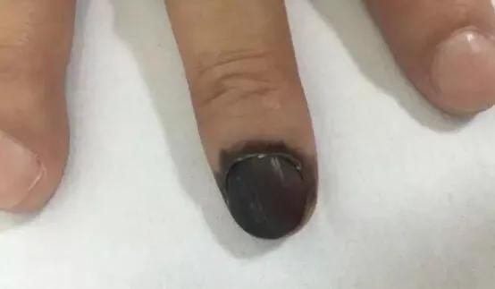 手指甲黑线怎么看是不是黑色素瘤,指甲有甲母痣会癌变吗