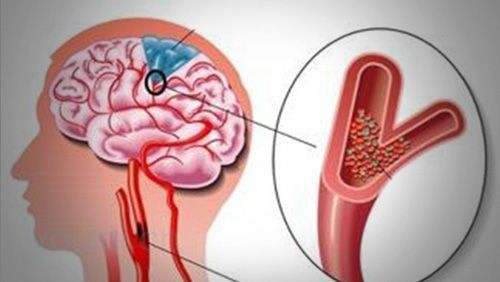 心血管狭窄用中药可以治愈吗,中药可以治疗血管狭窄吗
