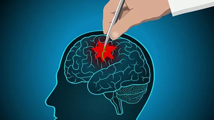 羊癫疯可以彻底治好吗,羊癫疯有什么办法能治好