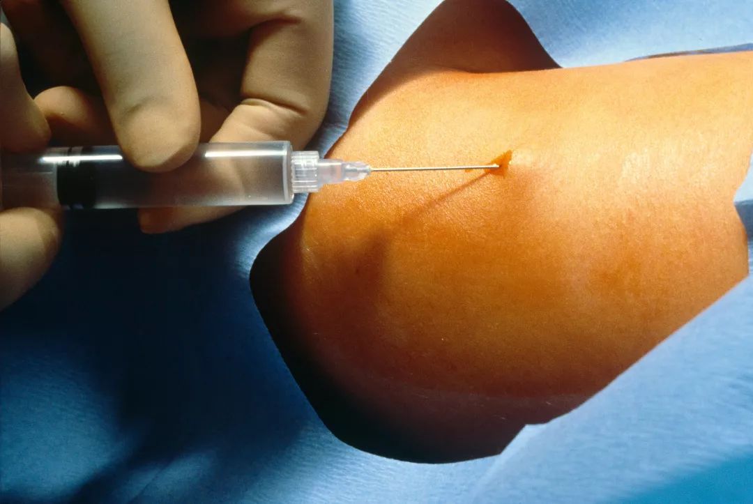 在美国做妇科手术,在美国做什么避孕手术