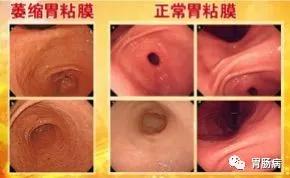 萎缩性胃炎与胃癌的关系,萎缩性胃炎与胃癌的症状区别