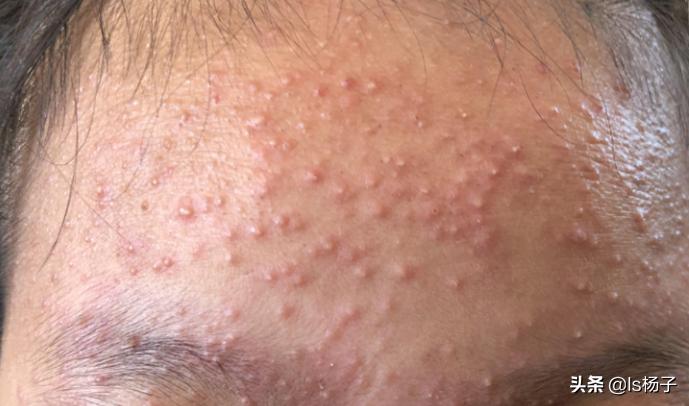 7岁孩子脸上起小米粒疙瘩有白尖,脸上长了好多小白尖的痘痘