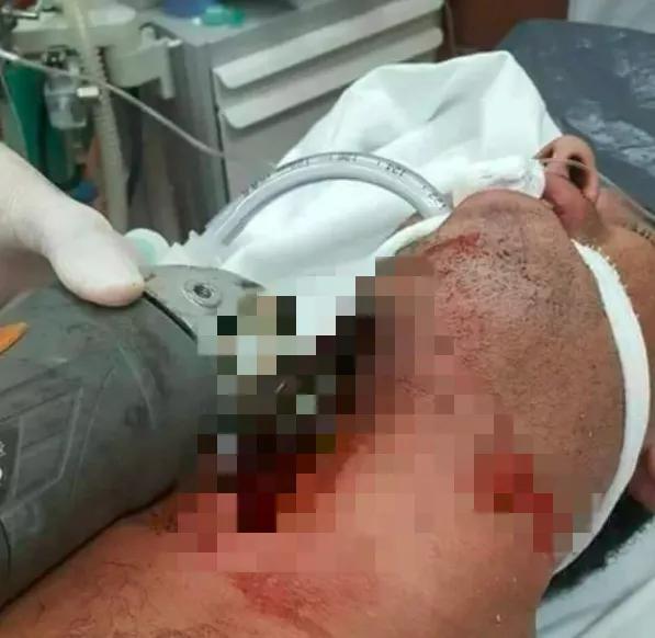 砂轮机会伤人吗,砂轮机伤人怎么防护