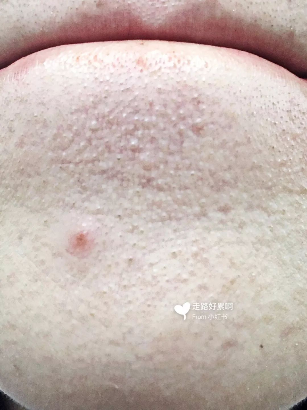 粉刺黑头真的没办法治疗吗,黑头粉刺不要清理会怎样