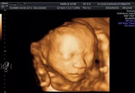 产检b超怎么看详细讲解,产检b超每次都查心脏