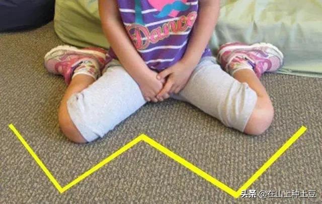 w坐姿真的可以矫正腿型吗,孩子w型腿坐怎么纠正