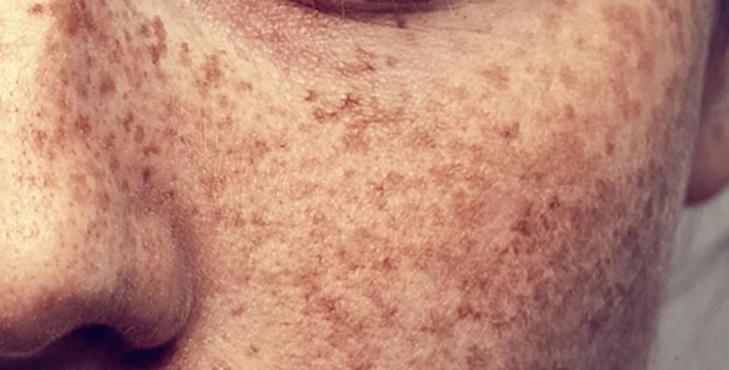 最近好像有点长斑了怎么可以改善,30岁开始长斑怎样来预防