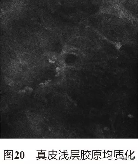 炎症性皮肤病反射式共聚焦显微镜诊断特征专家共识全文发布