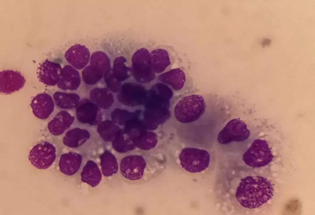 冷凝集素综合征是遗传性的吗,冷凝集素综合征夏季发作吗