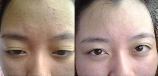 祛黑头平价护肤套装推荐,淡化黑头好用的大牌护肤品