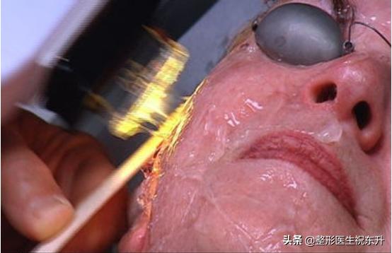 医生为何不做光子嫩肤,为什么医生不建议做光子