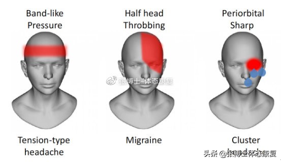 运动性头痛治疗,运动治愈偏头痛