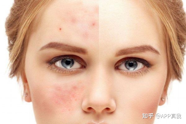 日常生活去痘印最好的方法,如何祛痘印小窍门简单有效