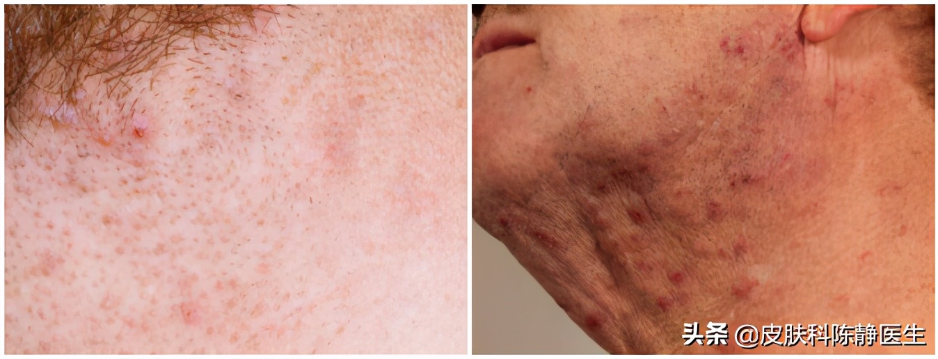 怎么避免一刮胡子就毛囊炎,刮胡子容易得毛囊炎怎么办