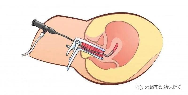 宫腔镜女性的福音先进设备,江西省妇幼保健院无痛宫腔镜