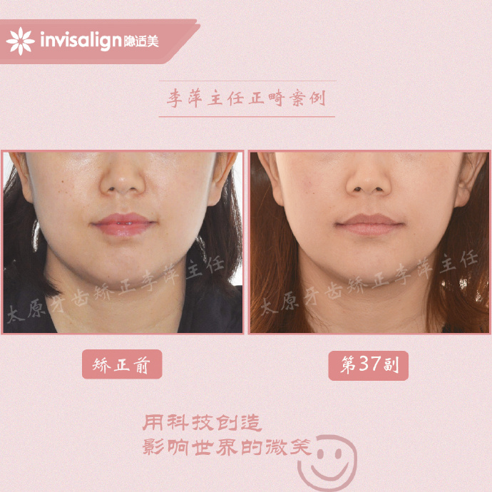 改善一侧咬肌,如何改善面型