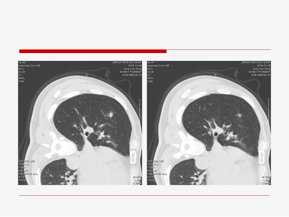 像炎症的肺癌能治好吗,医生说可能是肺癌也可能是炎症