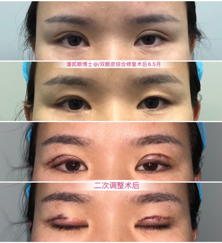 割双眼皮眼皮压下来会恢复吗,割双眼皮以后会松弛更快吗