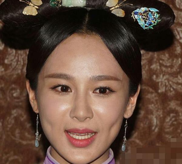 哪个明星做了颧骨内推,颧骨内推明星前后对比