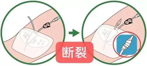 护士picc导管维护,护士picc相关知识薄弱