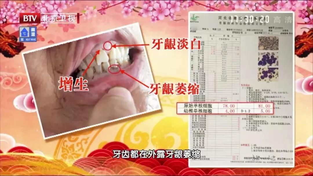 吃饭老塞牙缝怎么治疗,吃饭总塞牙你知道问题出在哪里吗