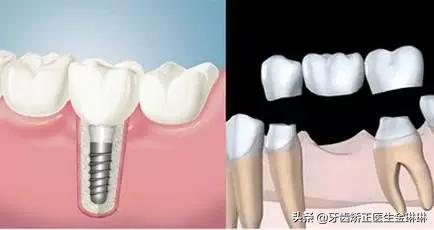 北京种后槽牙多少钱一颗,沈阳后槽牙种牙多少钱一颗
