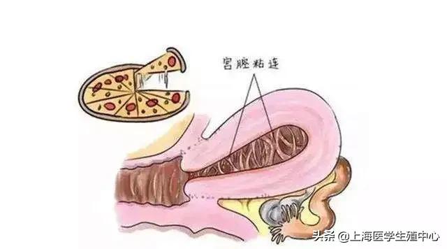 反复流产可能是卵子原因吗,流产次数过多会导致子宫恢复吗