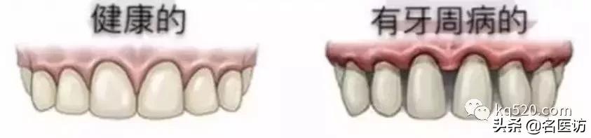 牙龈萎缩是什么原因引起的,牙龈萎缩专用药