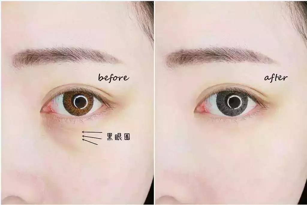 改善眼袋仅980元不开刀让你更出众,消除眼袋细纹大概多少钱