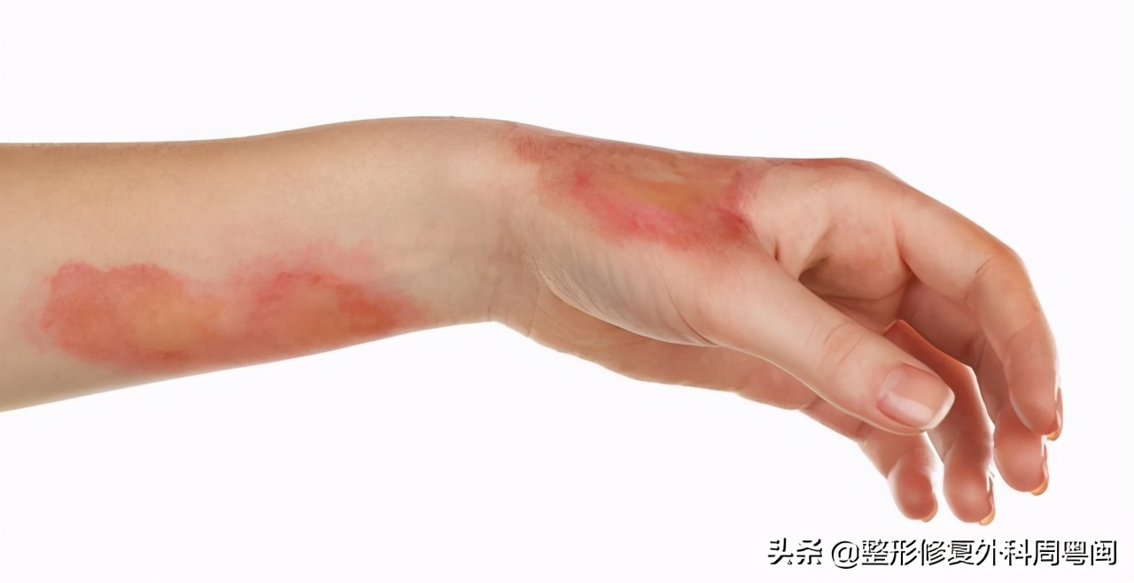 烧烫伤后如何止痒,烧烫伤后的局部处理