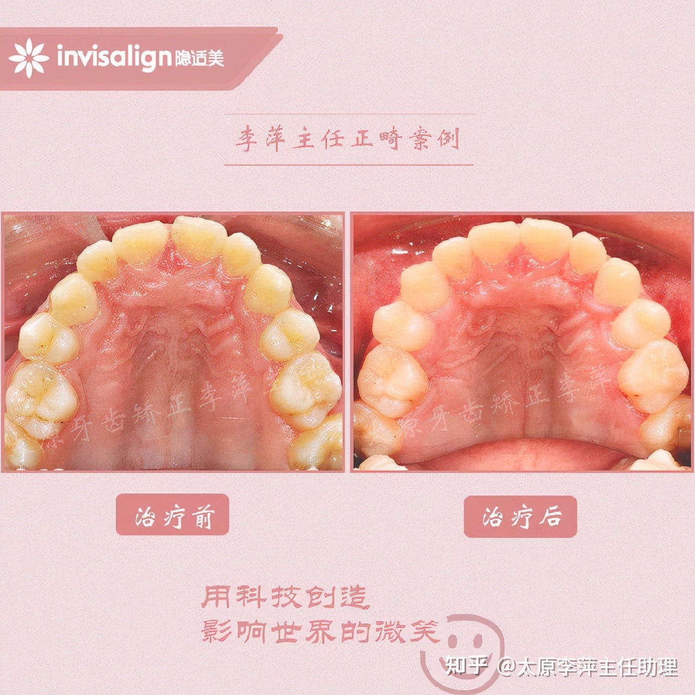 重度拥挤矫正牙齿适合隐形牙套吗,广州成人牙齿矫正推荐隐形牙套