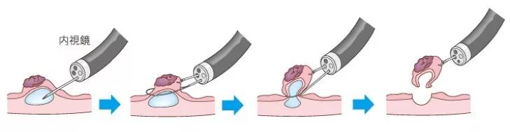 emr和esd消化内镜哪个好,内镜下esd和emr治疗的区别