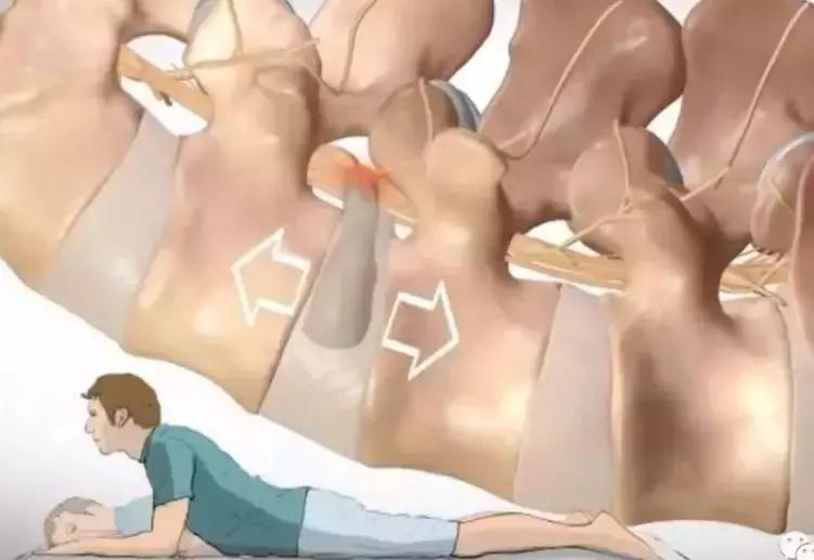 治疗腰间盘突出的最好锻炼方法,治腰间盘突出的最佳锻炼方法视频