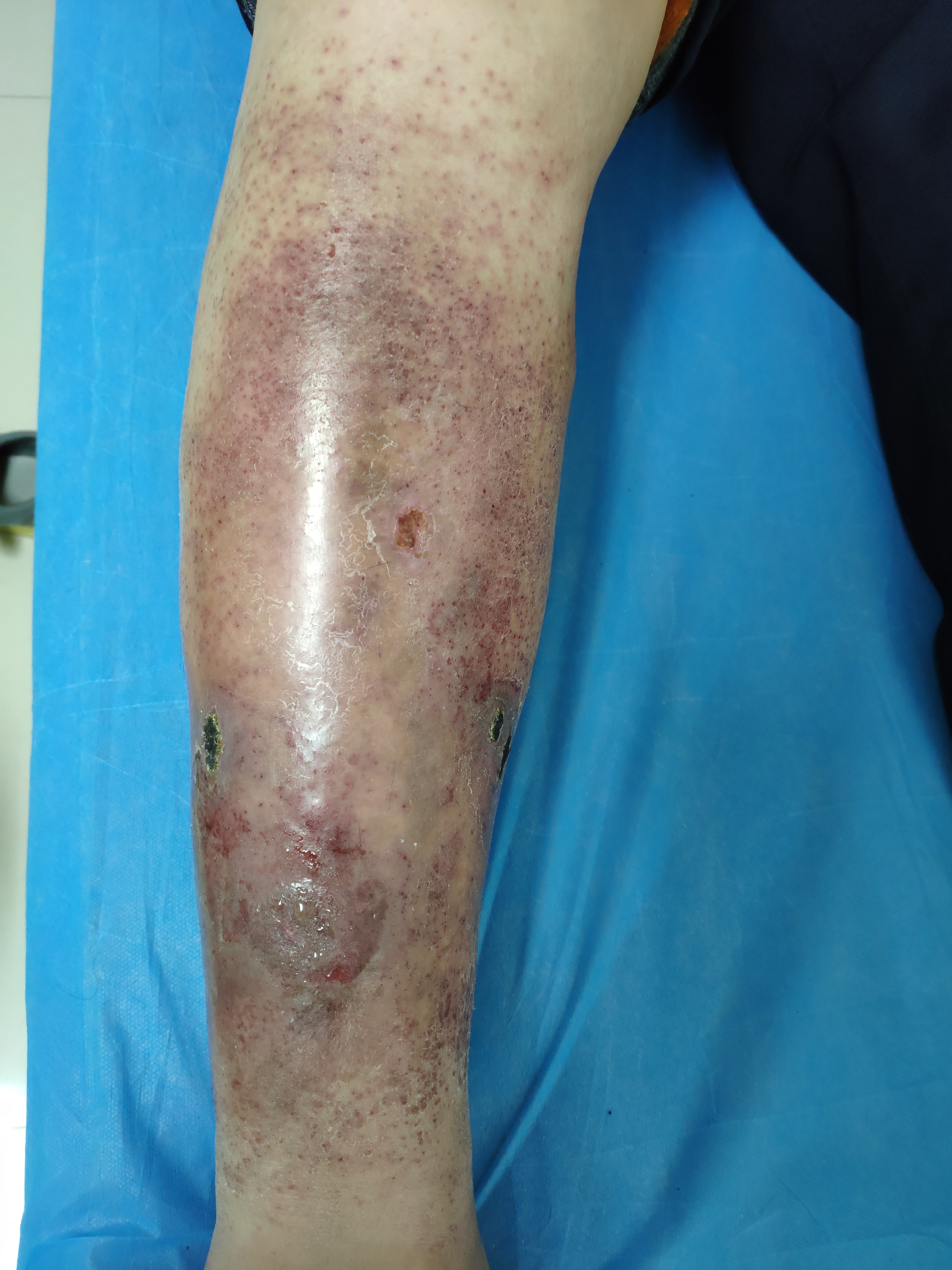 下肢皮肤溃烂吃什么,下肢皮肤瘙痒溃烂