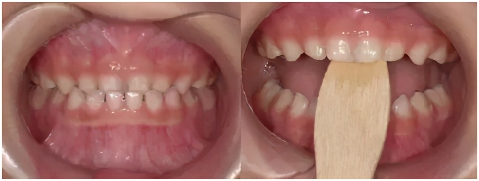 孩子嘴巴地包天有什么说法吗,小孩嘴地包天