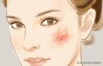 脸上总是有红血丝是怎么回事,脸上有红的血丝擦什么