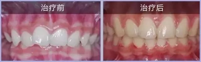 三岁孩子矫正牙齿后又反复,孩子牙齿矫正一个月看不到效果