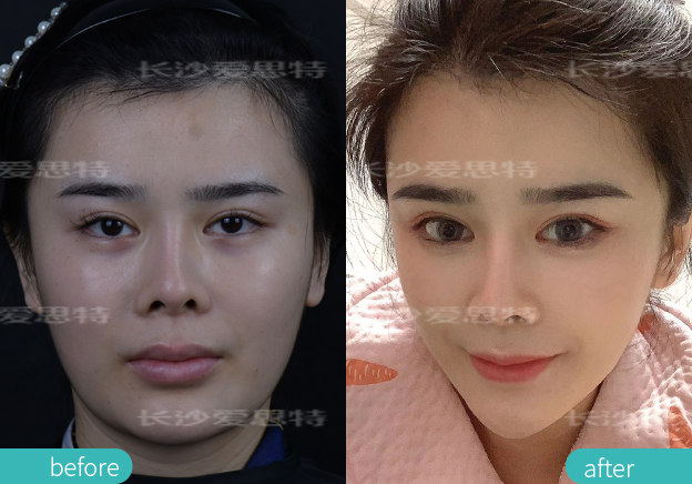 祛雀斑用皮秒好还是光子嫩肤好,祛斑用激光好还是光子嫩肤好一点