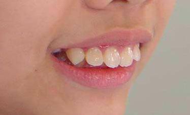 小朋友换牙歪歪扭扭,小孩换牙都长得歪歪扭扭怎么办