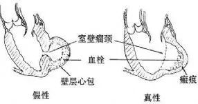 心脏的洞,心脏洞修补好还是封堵好