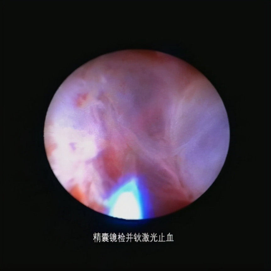 精子带血严重吗,精子带血严重么